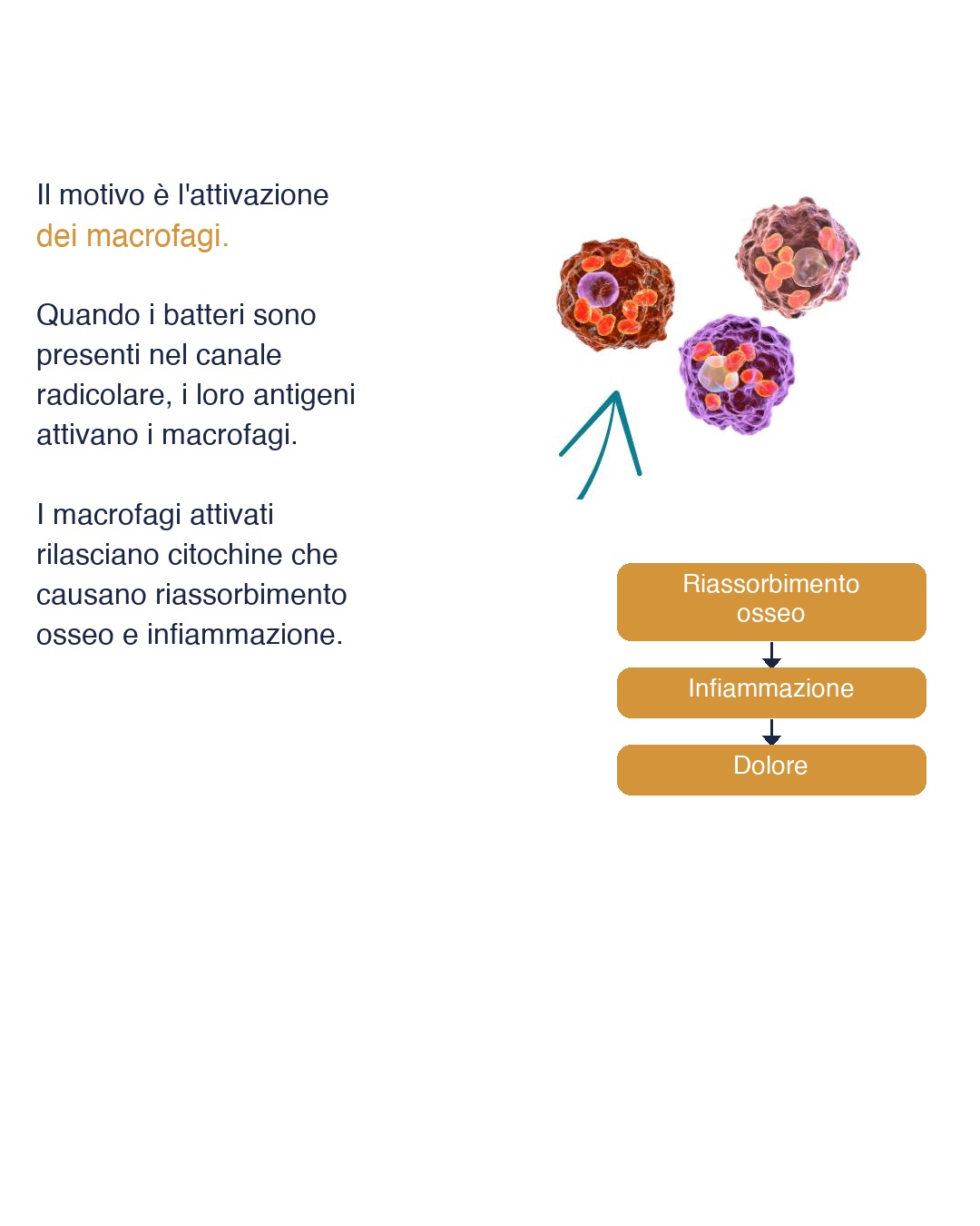 Infografica: meccanismo biologico del dolore post-endodontico — macrofagi e citochine
