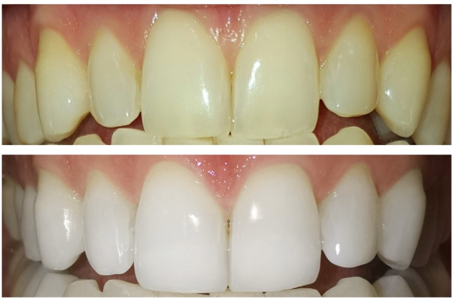 Sbiancamento denti Bergamo prima e dopo - arcata superiore