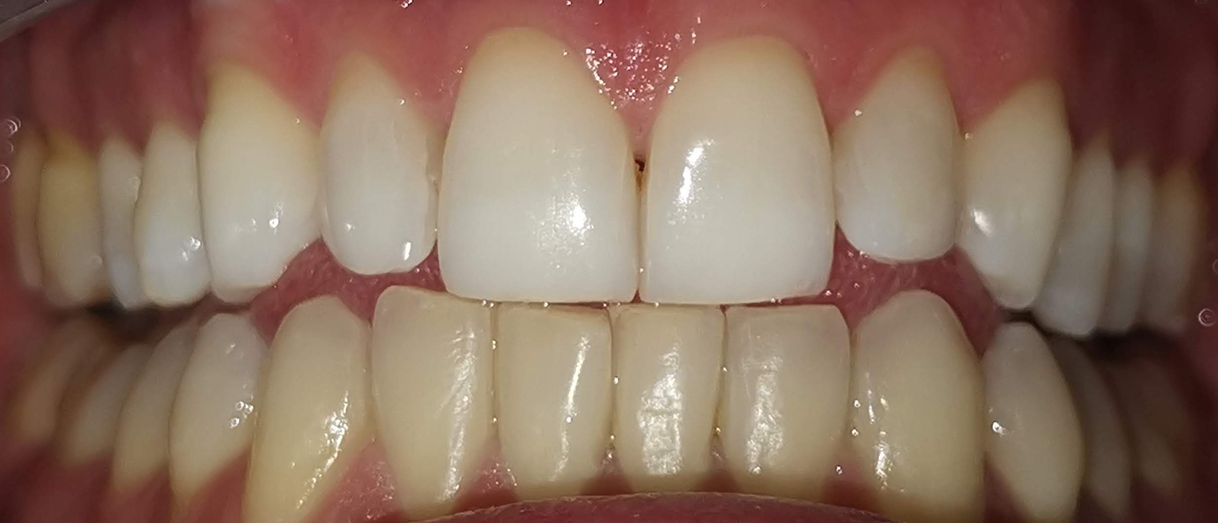 Confronto sbiancamento denti professionale - arcata superiore sbiancata vs inferiore