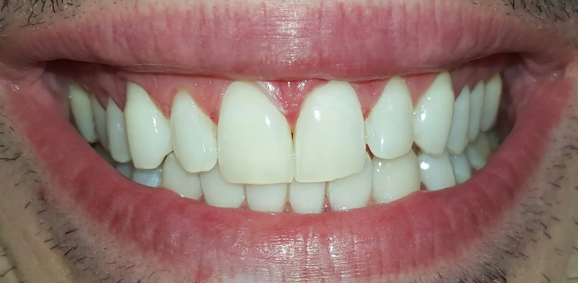Risultato finale sbiancamento denti professionale Bergamo - sorriso completo